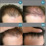 HAIR_TRANSPLANT_PATIENT-23-500.jpg