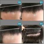 HAIR_TRANSPLANT_PATIENT-23-600.jpg