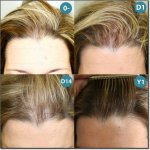 FEMME_GREFFE_CHEVEUX_200.jpg