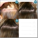 FEMME_GREFFE_CHEVEUX_500.jpg