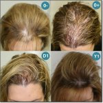 FEMME_GREFFE_CHEVEUX_300.jpg