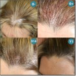 FEMME_GREFFE_CHEVEUX_400.jpg