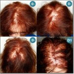 WOMEN-HAIR-DENSITY-200.jpg