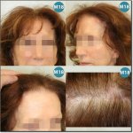 WOMEN-HAIR-DENSITY-400.jpg