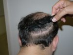 Donor at 6 months.JPG