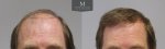 796-Before_after_front.jpg