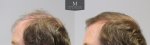 796-Before_after_left.jpg