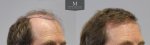 796-Before_after_right45.jpg