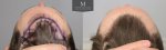 ID719-Before-after_above_hairine.jpg