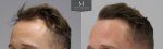 ID719-Before-after_left45.jpg