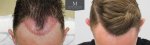 ID719-Before-after_hairline_graft_placement.jpg