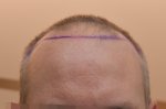 pre op hair line drawn.jpg