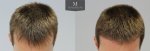 1878 Grafts FUE, The Maitland Clinic, Dr Edward Ball, 9 month post op, double, Front tilt.jpg