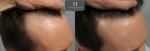 1878 Grafts FUE, The Maitland Clinic, Dr Edward Ball, 9 month post op, double, Right 45(1).jpg
