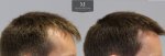 1878 Grafts FUE, The Maitland Clinic, Dr Edward Ball, 9 month post op, double, Right.jpg