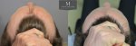 1878 Grafts FUE, The Maitland Clinic, Dr Edward Ball, 9 month post op, double, pull back.jpg