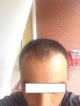 Dr Bicer FUE Hair Transplant.jpg