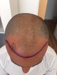 Dr Bicer FUE Hair Transplant 3.JPG
