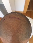 Dr Bicer FUE Hair Transplant 4.JPG