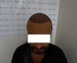 Dr Bicer FUE Hair Transplant 5.JPG