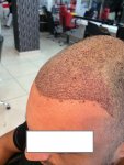 Dr Bicer FUE Hair Transplant 6.jpg