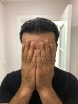 Dr Bicer FUE Hair Transplant 9.jpg