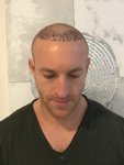 Dr Bicer Hair Transplant. 1.jpg