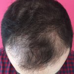 FUE hair transplant Turkey 1.jpg
