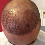 FUE hair transplant Turkey 2.jpg