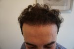 FUE hair transplant Turkey 4.jpg