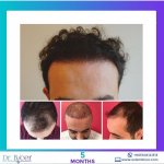 FUE hair transplant Turkey 3.jpg