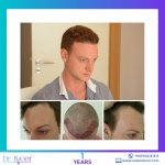 Dr. Özlem Biçer - Turkey FUE Hair Restoration (2).jpg