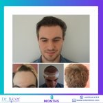 Dr. Özlem Biçer - Turkey FUE Hair Restoration.jpg