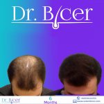 Dr. Özlem Biçer - Turkey FUE Hair Transplant (3).jpeg