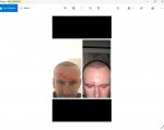 Dr Acar hair transplant Turkey.JPG