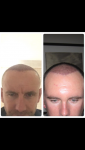 Hair transplant Turkey Cosmedica 1.PNG