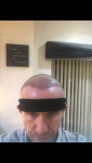 Hair transplant Turkey Cosmedica 2.PNG