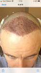 Hair transplant Turkey Cosmedica 3.PNG