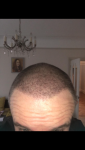 Hair transplant with Dr Acar Cosmedica.png