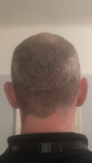 Cosmedica Hair transplant Turkey.png