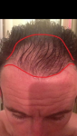 Hair transplant with Dr Acar Cosmedica before surgery.png