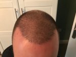 Dr Feriduni hair transplant 3.jpg