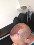 Dr Feriduni FUE hair transplant repair.jpg