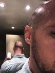 Dr Feriduni FUE hair transplant repair surgery.jpg