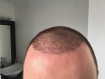 hair transplant repair surgery 4.jpg