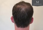 Dr Edward Maitland Ball  Hair Transplant 7.jpg