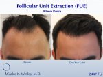 Hair Transplant with Dr Carlos Wesley2.jpeg