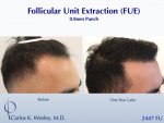 Hair Transplant with Dr Carlos Wesley3.jpeg