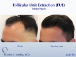 Hair Transplant with Dr Carlos Wesley4.jpeg