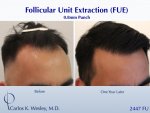 Hair Transplant with Dr Carlos Wesley5.jpeg